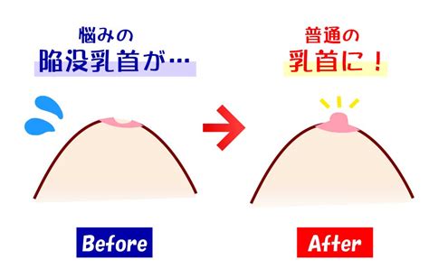 乳首 が 立た ない|陥没乳首の原因は？引き起こされる問題と治し方 .